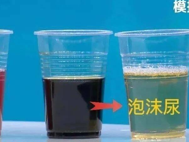 喝水后4个异常，可能是肾发出的“求救信号”！
