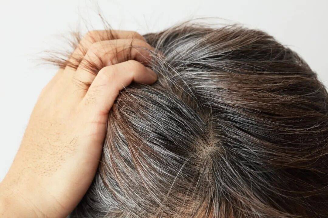 白头发越长越多，可能是缺这 3 种营养了！