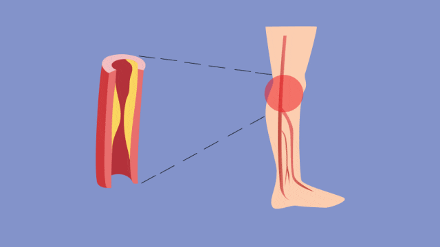 有种腿疼提示血管堵了，走路出现3种异样要留心