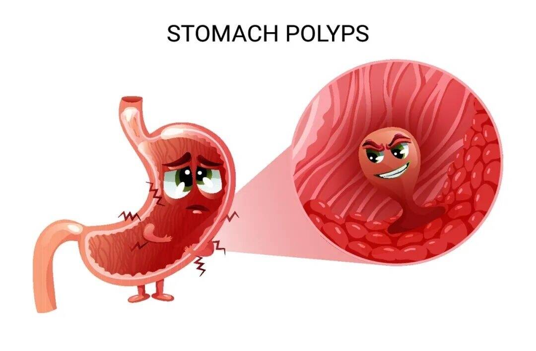 肠道里长了息肉，上厕所时会有 4 个提示，别等到肠癌才后悔！