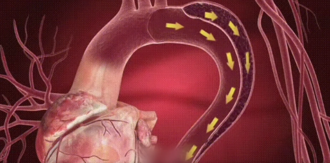 警惕！这种病比心梗还凶险