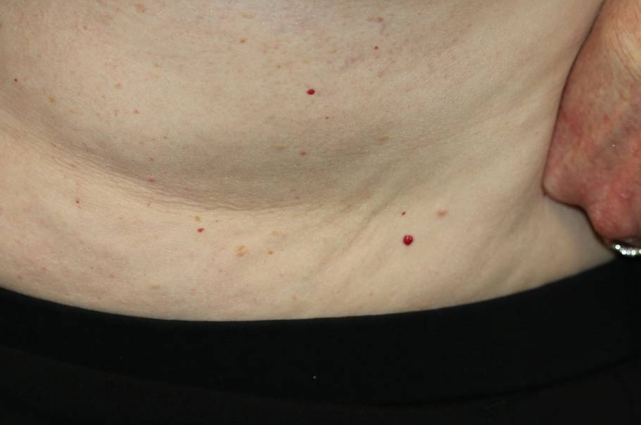 身上突然长的小红点，到底是什么？会癌变吗？