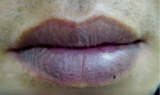 嘴唇发紫就是心脏不好吗？先别急，更重要的是看这一点