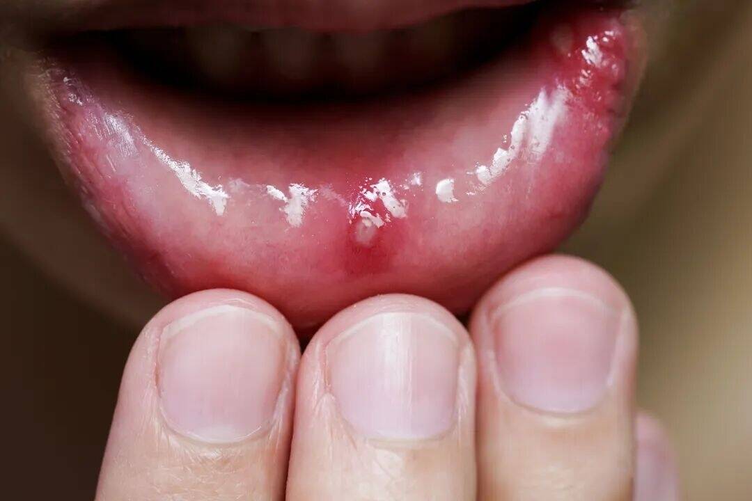 健康 | 嘴巴疼千万别硬扛，这种&ldquo;小毛病&rdquo;拖着不治，可能要命